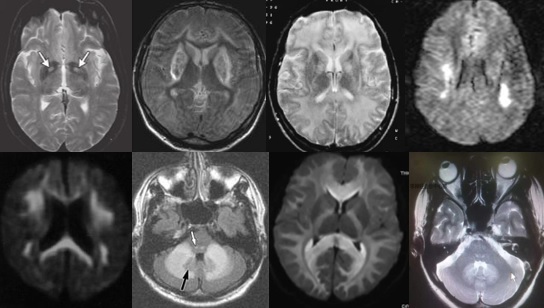 中枢神经脱髓鞘病是重大疾病吗,中枢神经系统脱髓鞘和多发性硬化