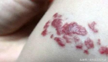 胎记按病因分为几类,胎记的原因及解决方法