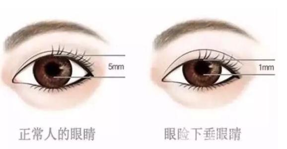 小宝宝一只双眼皮，一只单眼皮，是影响美观？还是眼睛在求救？