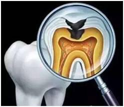 中年人如何防止蛀牙扩散,老年人蛀牙已经烂空了怎么办