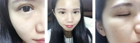 做双眼皮是如何打麻药的,其实做双眼皮没想象中那么疼