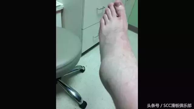 怎么快速恢复崴伤的脚踝,如何彻底治愈脚踝陈旧性扭伤