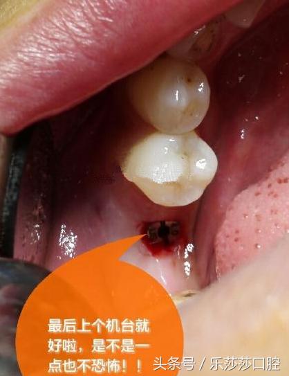种植牙到底有多痛苦,种植牙真实经历详细全部过程