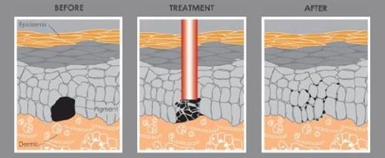 激光祛斑反弹最真实的经历,都说激光祛痘没用是真的吗