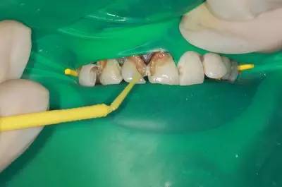 目前补救可乐牙最好的办法,可乐牙的治疗贵么