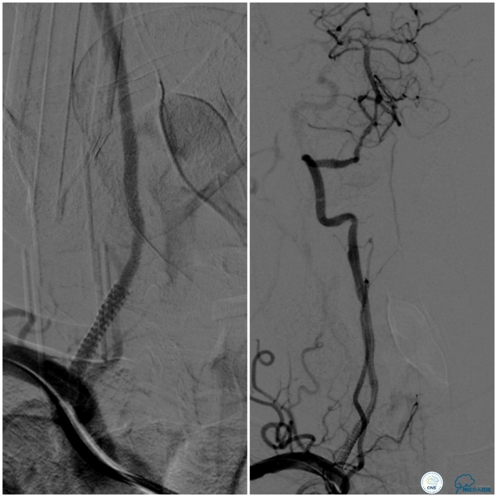 天坛周记|右椎动脉V1段及V4-基底动脉串联病变支架治疗一例