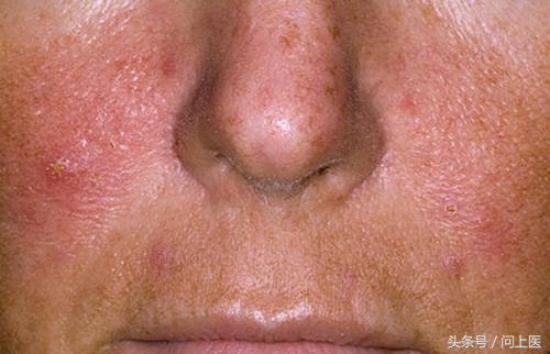 图解成年人常见的皮肤问题