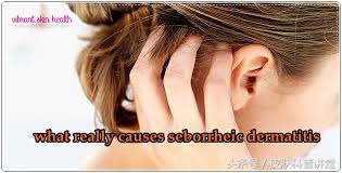 头皮屑多且脂溢性皮炎,头皮屑多头痒脂溢性皮炎