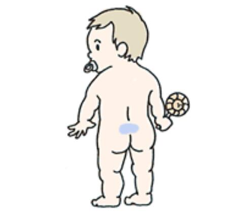 隐性脊柱裂属于先天性疾病吗,先天脊柱裂是先天疾病吗