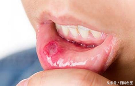 哪些病会引起口腔溃疡,什么样的口腔溃疡要警惕