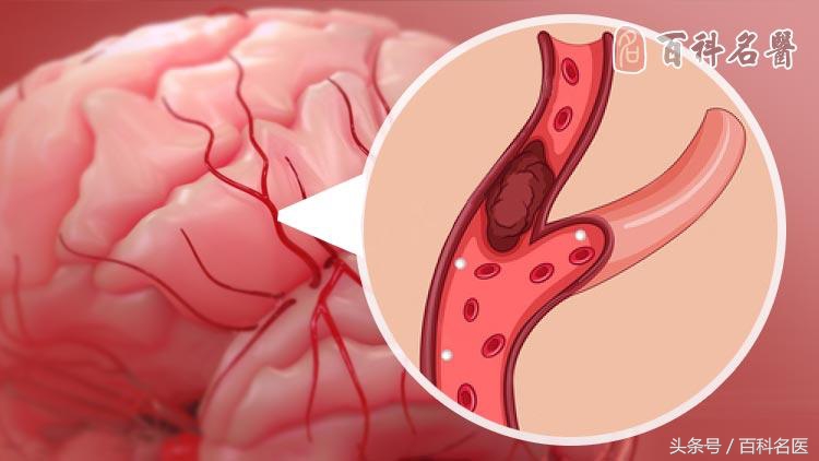 脑血栓有前兆当心这7个症状,脑血栓早期都有哪些症状