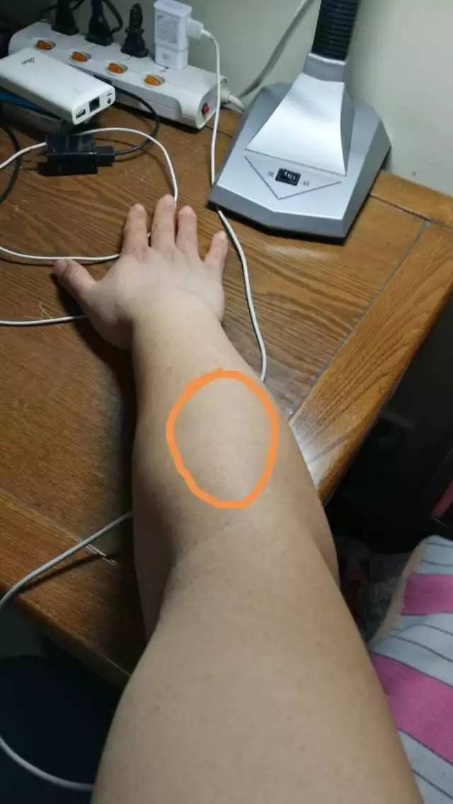 答疑（18）：瘦小腿不太容易（伤病类答疑）