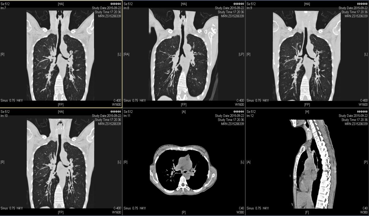 反复咳嗽咳痰气喘5年,长期咳嗽气短久治不愈的原因