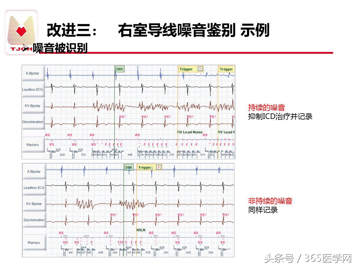 许静：新技术避免ICD不恰当放电