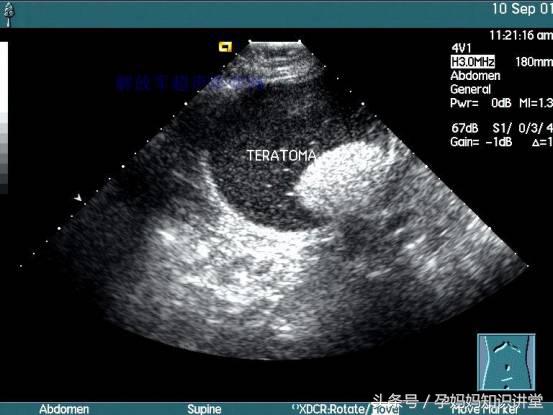 b超检查方法及注意事项,b超检查的注意事项