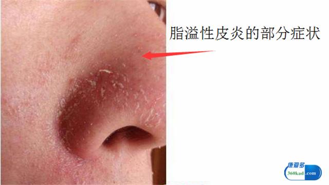 鼻子两侧有红血丝是什么原因,鼻子两边有红血丝有什么办法