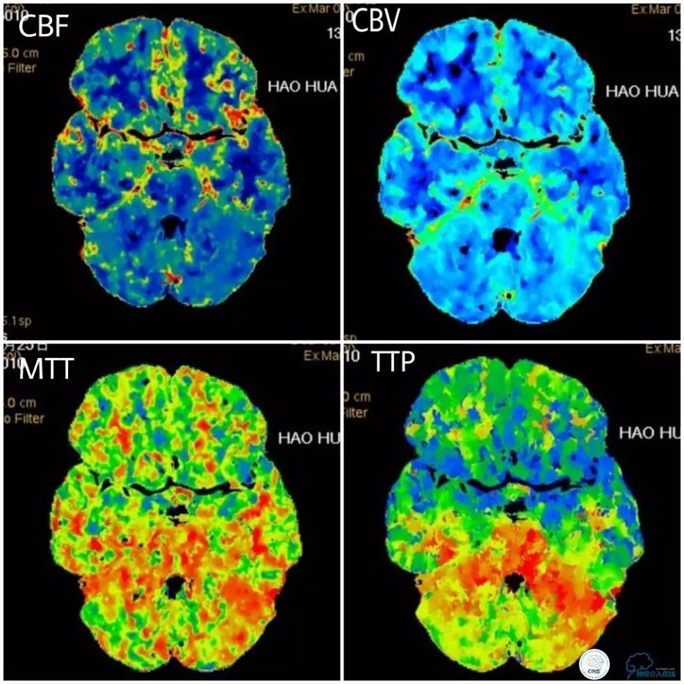 天坛周记|右椎动脉V1段及V4-基底动脉串联病变支架治疗一例