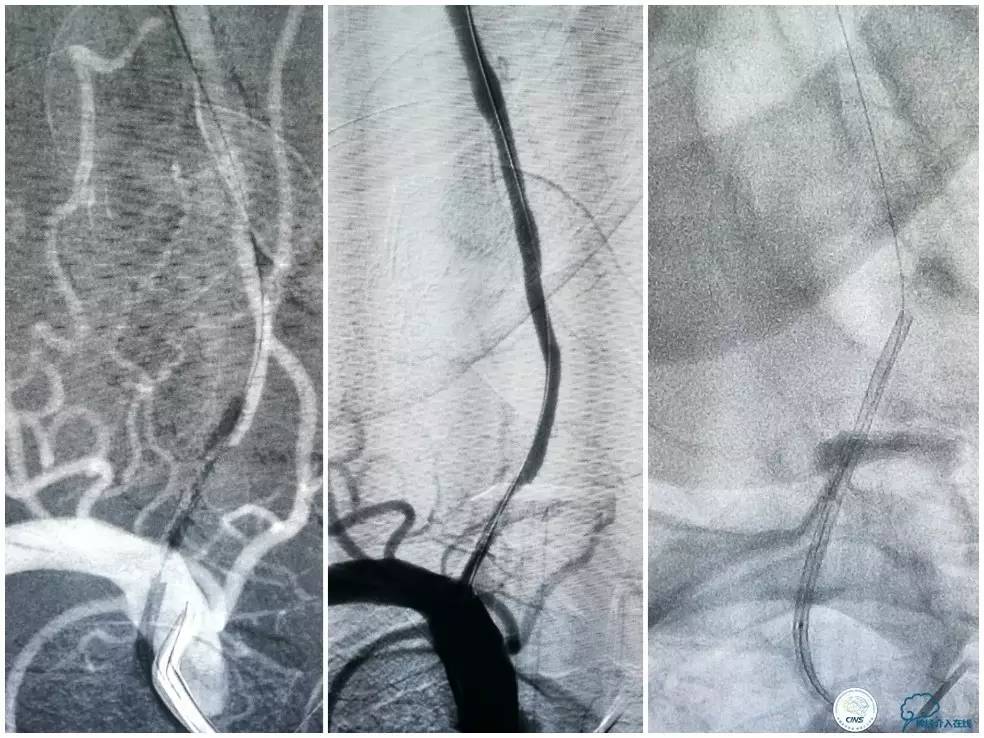 天坛周记|右椎动脉V1段及V4-基底动脉串联病变支架治疗一例