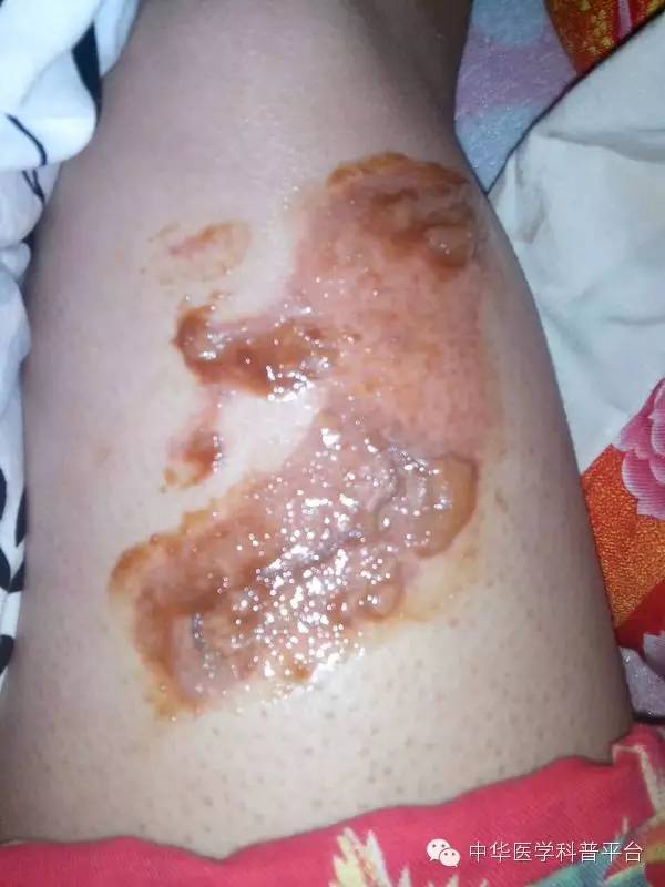 烫伤的紧急处理谣言,烫伤的紧急处理方法卡通