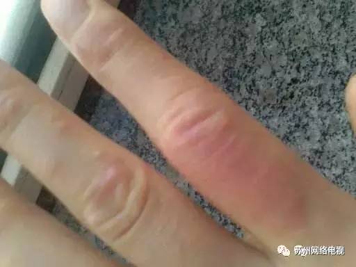 苏州一女子连续一周高烧不退,皮肤大面积溃烂用什么消炎药