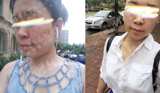 分享我的4年战痘经验,战痘能手护肤常识