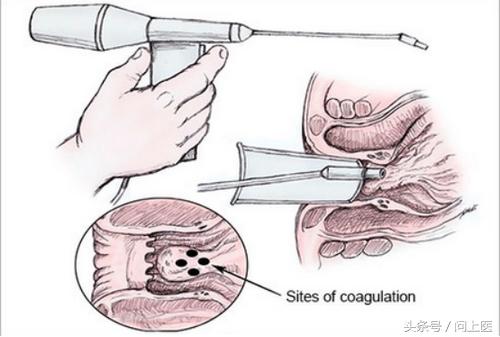 肛肠疾病你到底了解多少,痔疮知识自测
