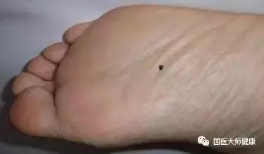 突然长出来的痣要切吗,乳房突然长痣会癌变吗