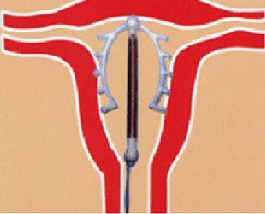 突然上节育环,节育环莫名其妙出现