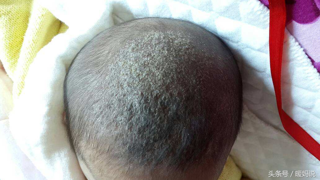 怎么管住手不抠痘痘,宝宝的头痂怎么去