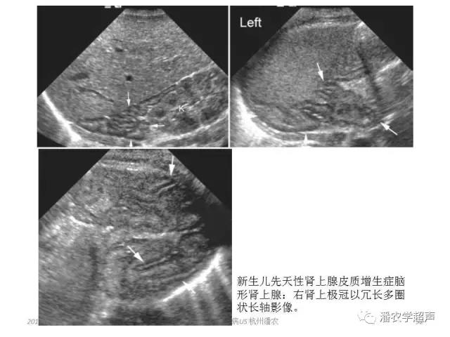 小儿肾上腺囊性占位超声表现,肾上腺疾病的影像学诊断