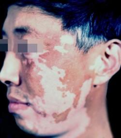 uvb治疗白癜风,uvb治疗白癜风时能照射好的皮肤吗