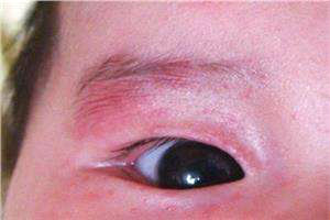 宝宝有眼屎多且黄还粘稠是上火吗,宝宝眼屎又黄又多怎么回事