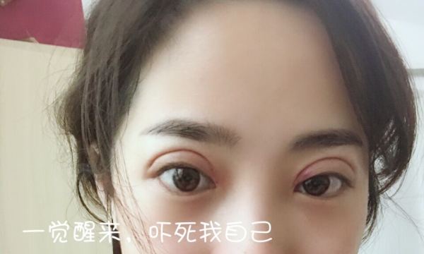 鼓起勇气做了个双眼皮,鼓起勇气做了医美