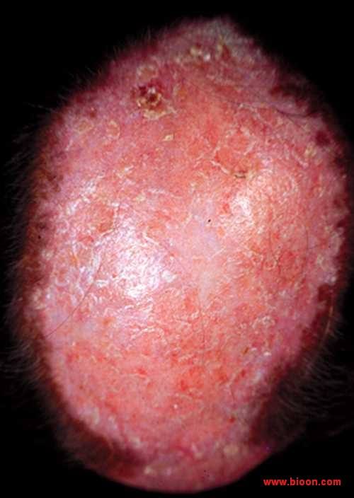 皮肤型红斑狼疮用什么药膏,皮肤型红斑狼疮的饮食