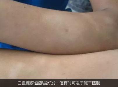 不是白癜风的白斑能查出是什么吗,不是白癜风的白点是啥