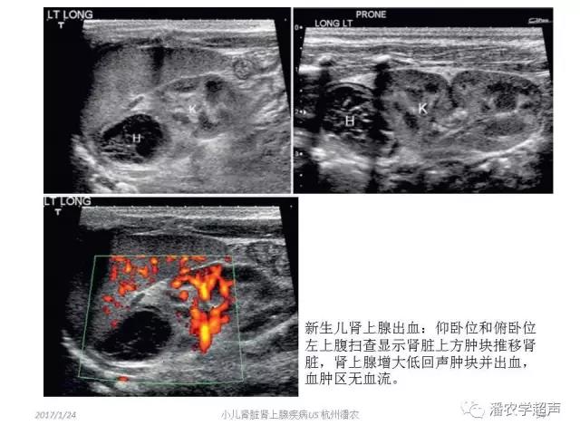 小儿肾上腺囊性占位超声表现,肾上腺疾病的影像学诊断