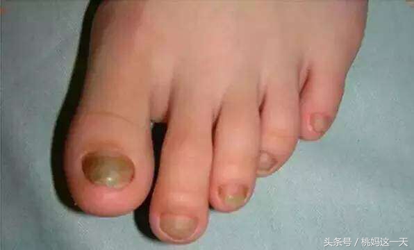 一岁宝宝剪指甲变黄,宝宝指甲黄色怎么回事