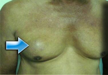 男性乳腺癌最新研究,男性乳腺癌自述