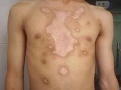 介入治白癜风与细胞培植一样吗,手指白癜风适合细胞培植吗