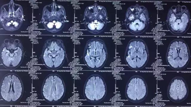 奇迹！跨越600公里疾速异地协作百草枯中毒患者起死回生