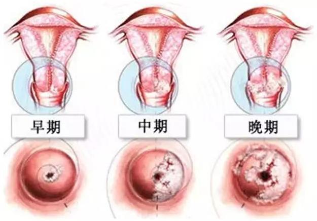 宫外孕大出血需要怎么处理,宫外孕为什么会引起大出血