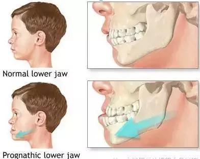 什么时候适合做矫正,什么时候整牙矫正最好