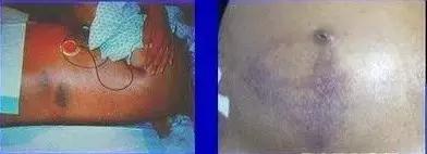 腹痛的辨证范畴,腹痛鉴别