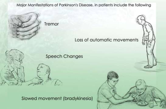 阿里得了帕金森还上过拳台吗,阿里得了帕金森为什么还要打拳