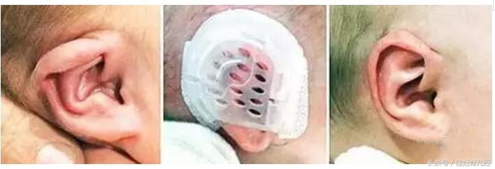 新生婴儿招风耳怎么矫正,招风耳宝宝命不好