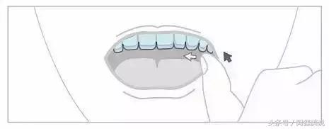 隐适美矫正摘戴攻略,隐适美和正雅隐形矫正哪个好
