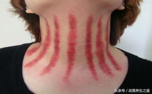 刮痧把脸刮肿了怎么办,为什么第一次刮痧有点晕