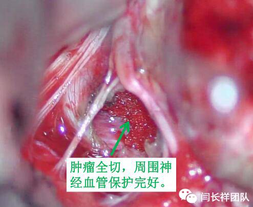 舌头突然不利索,舌头突然间不好使一会就好了