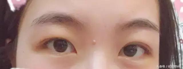 真实贴双眼皮贴,单眼皮怎么贴第二天变双眼皮