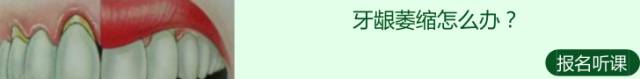 防止磨牙的牙套到底有没有用,磨牙严重牙套推荐